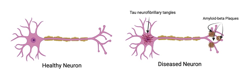 Figure 1, displaying a healthy neuron compared to a diseased one.